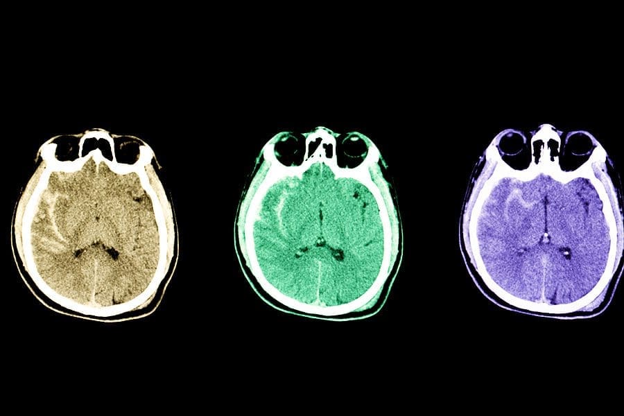 Lasting Consequences of Traumatic Brain Injuries - Jones Law Group