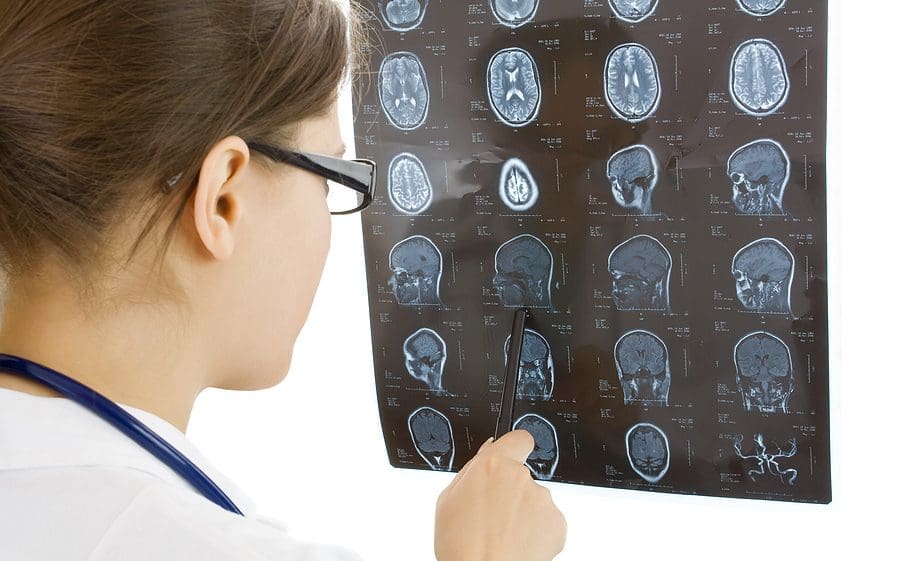 Types of Brain Injuries Caused By Car Accidents - Jones Law Group
