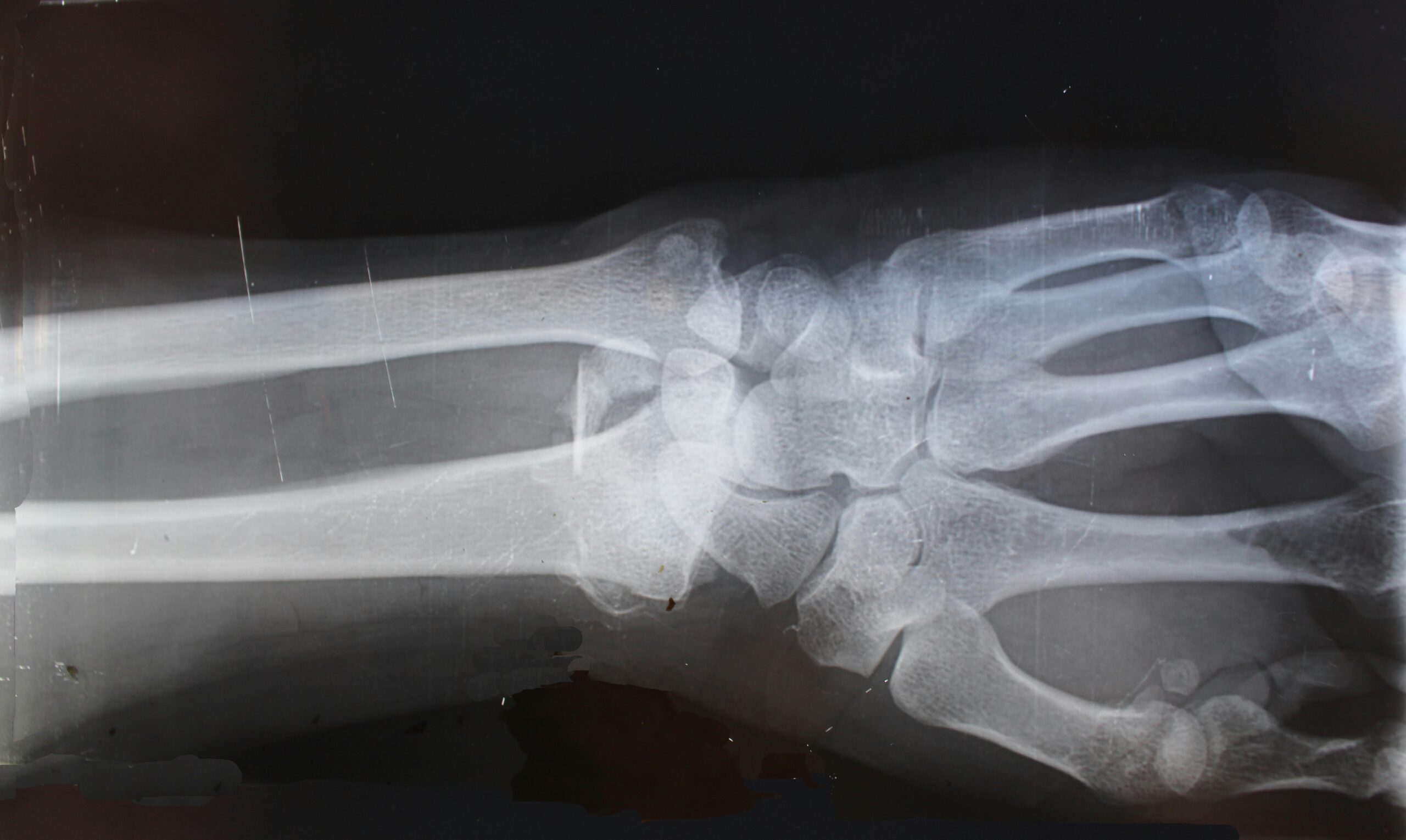x-ray of a broken and fractured bone